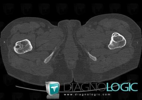 Fibrous dysplasia, Femur - Proximal part, CT