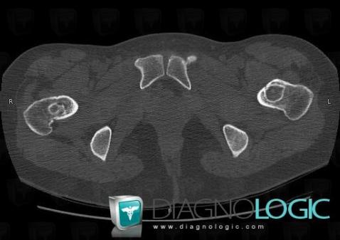 Fibrous dysplasia, Femur - Proximal part, CT