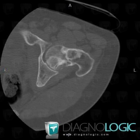 Fibrous dysplasia, Femur - Proximal part, CT