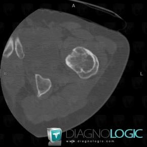 Fibrous dysplasia, Femur - Proximal part, CT