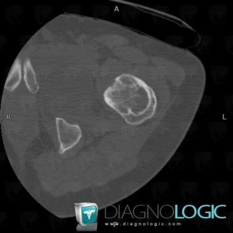 Fibrous dysplasia, Femur - Proximal part, CT