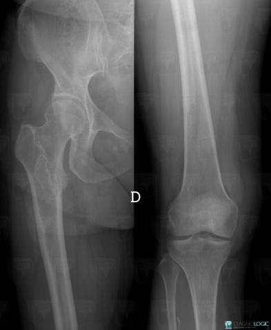 Fibrous dysplasia, Femur - Proximal part, X rays