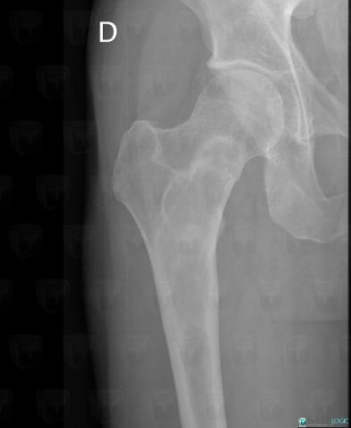 Fibrous dysplasia, Femur - Proximal part, X rays