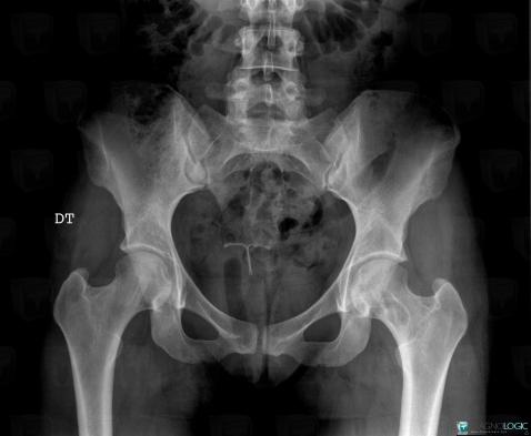 Fibrous dysplasia, Femur - Proximal part, X rays