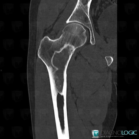 Fibrous dysplasia, Femur - Proximal part, X rays, CT