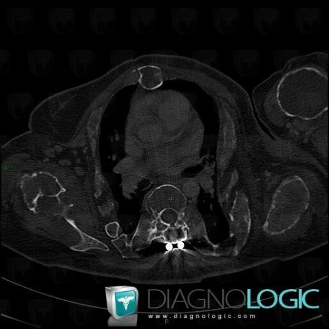 Fibrous dysplasia, Humerus - Mid part, CT