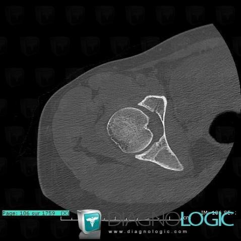 Fibrous dysplasia, Ilium, CT