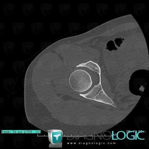 Fibrous dysplasia, Ilium, CT