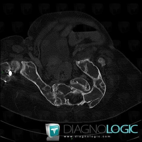 Fibrous dysplasia, Ilium, CT