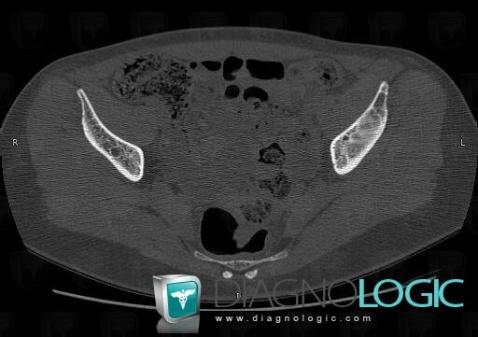 Fibrous dysplasia, Ilium, CT