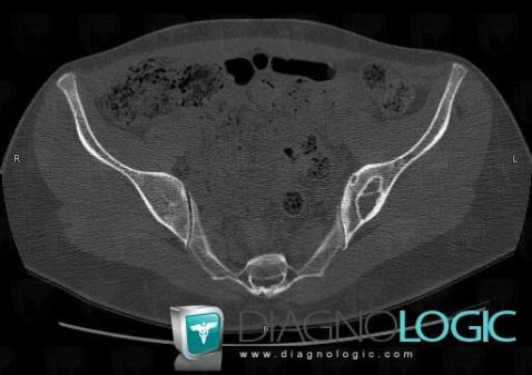 Fibrous dysplasia, Ilium, CT