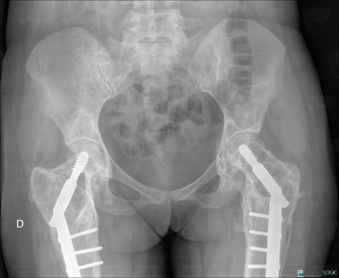 Fibrous dysplasia, Ilium, Femur - Proximal part, X rays