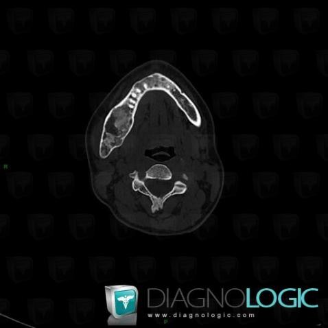 Fibrous dysplasia, Maxilla, CT