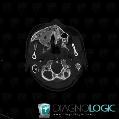 Fibrous dysplasia, Maxilla, CT