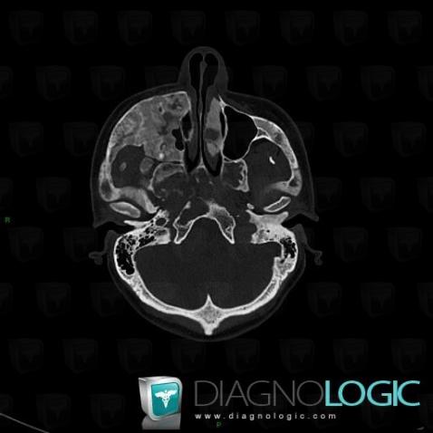 Fibrous dysplasia, Maxilla, CT