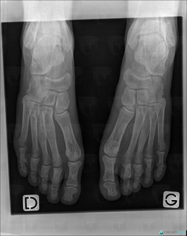 Fibrous dysplasia, Metatarsal bones, Phalanx / Sesamoid bones - Foot, X rays