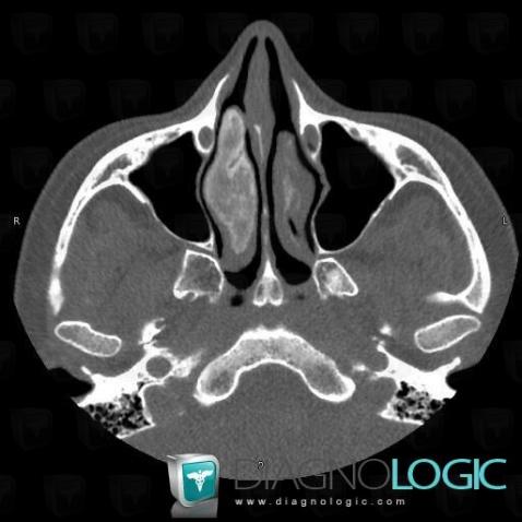 Radiology case : Fibrous dysplasia (CT) - Diagnologic