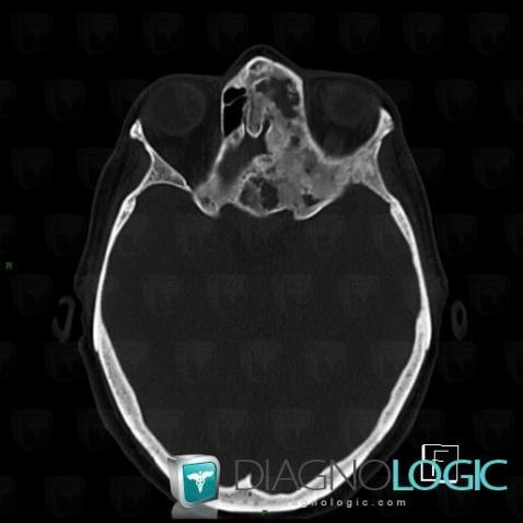 Fibrous dysplasia, Orbital bones, CT