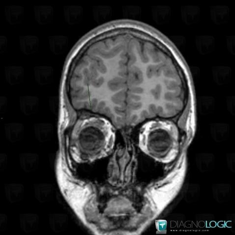 Fibrous dysplasia, Orbital bones, MRI