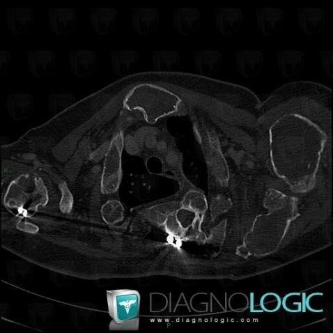 Fibrous dysplasia, Ribs, Sternum, CT