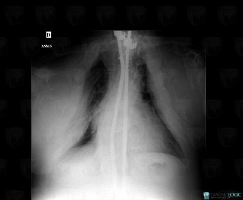 Fibrous dysplasia, Ribs, X rays