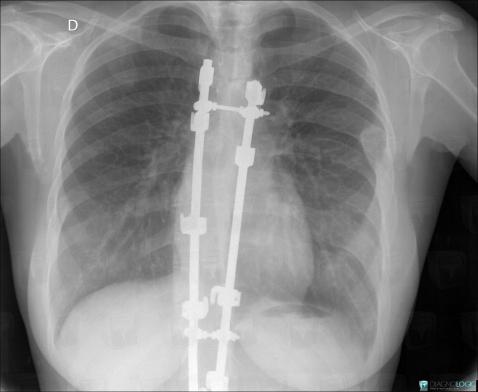 Radiology case : Fibrous dysplasia (X rays ,CT) - Diagnologic