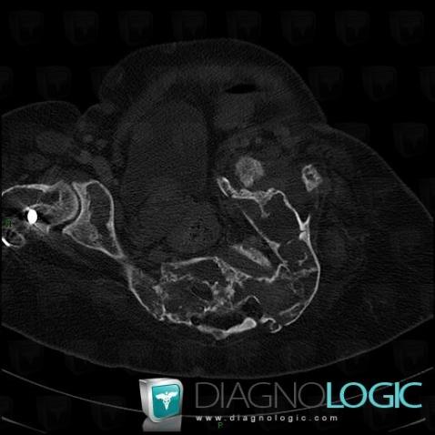 Fibrous dysplasia, Sacrum / Coccyx, CT