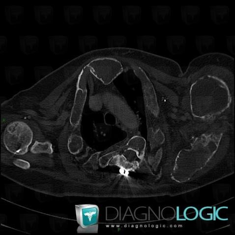 Fibrous dysplasia, Scapula, Humerus - Proximal part, CT