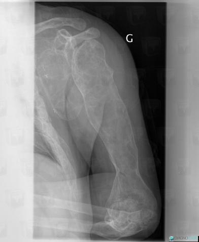 Fibrous dysplasia, Scapula, Humerus - Proximal part, X rays