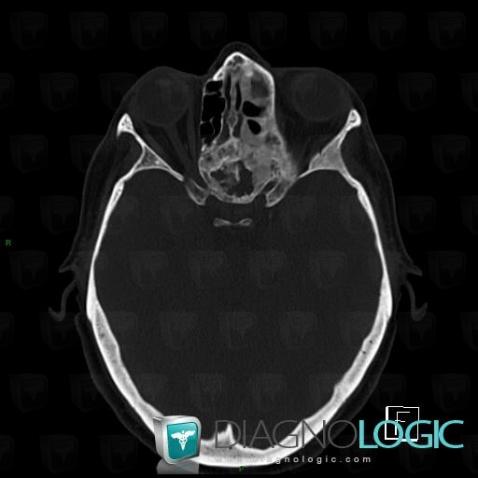 Fibrous dysplasia, Sinus, CT