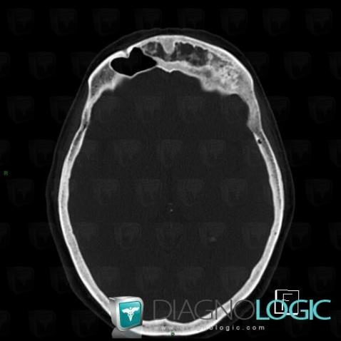 Fibrous dysplasia, Skull vault, CT