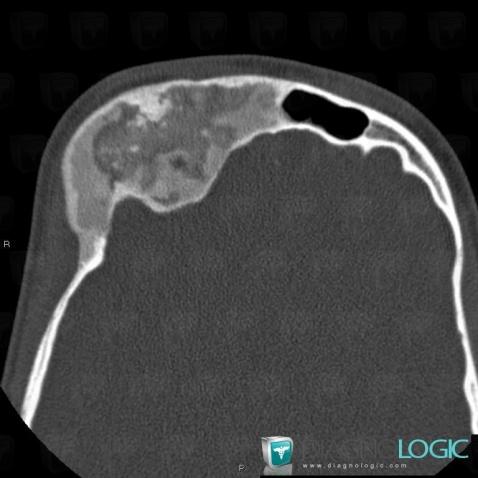 Fibrous dysplasia, Skull vault, CT