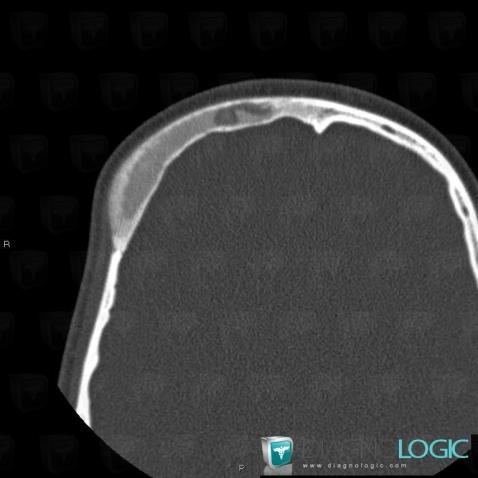 Fibrous dysplasia, Skull vault, CT