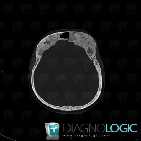 Fibrous dysplasia, Skull vault, CT