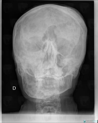 Fibrous dysplasia, Skull vault, Maxilla, X rays