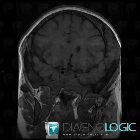 Fibrous dysplasia, Skull vault, MRI