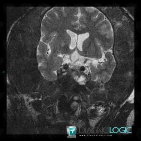 Fibrous dysplasia, Skull vault, MRI