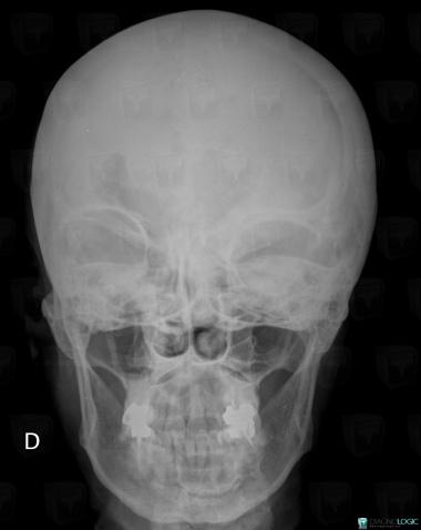 Fibrous dysplasia, Skull vault, Orbital bones, X rays