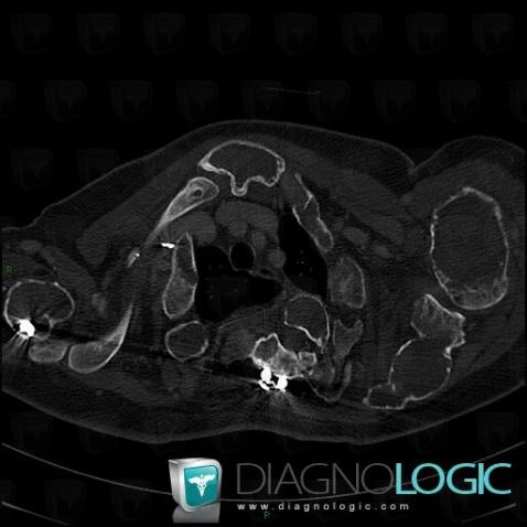 Fibrous dysplasia, Skull vault, Sphenoid bone, X rays, CT