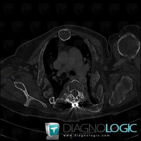 Fibrous dysplasia, Skull vault, Sphenoid bone, X rays, CT