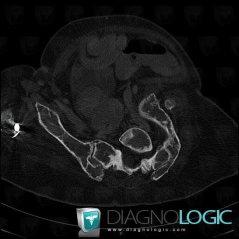 Fibrous dysplasia, Skull vault, Sphenoid bone, X rays, CT