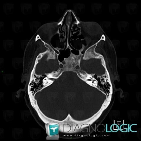 Fibrous dysplasia, Sphenoid bone, CT