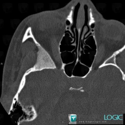 Fibrous dysplasia, Sphenoid bone, CT