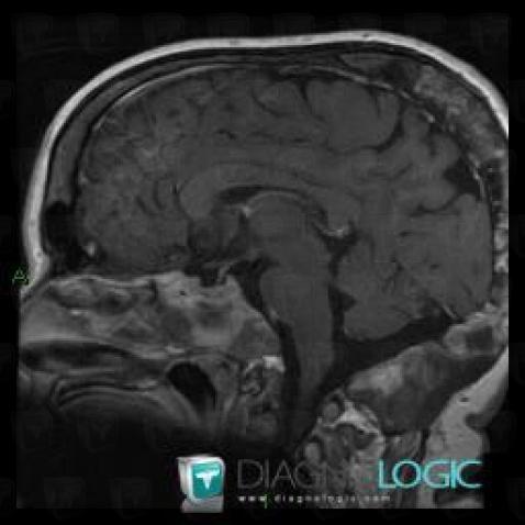 Fibrous dysplasia, Sphenoid bone, MRI