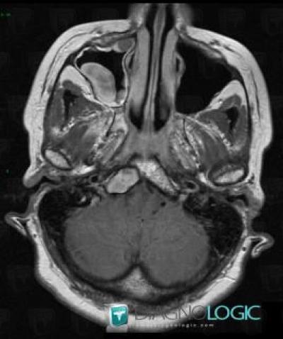 Fibrous dysplasia, Sphenoid bone, MRI