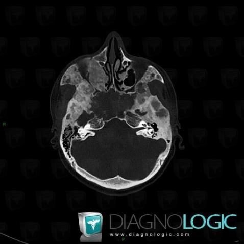 Fibrous dysplasia, Temporal bone, Sphenoid bone, CT