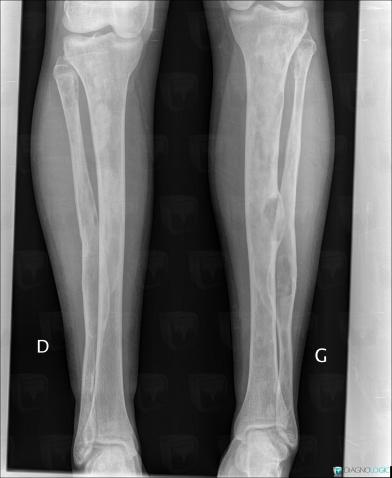 Fibrous dysplasia, Tibia - Proximal part, Fibula - Proximal part, X rays