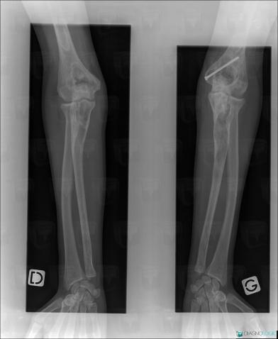 Fibrous dysplasia, Ulna - Proximal part, Ulna - Mid part, X rays