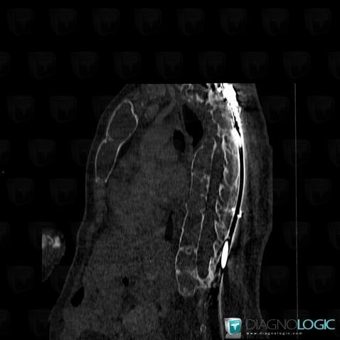 Fibrous dysplasia, Vertebral body / Disk, CT