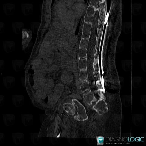 Fibrous dysplasia, Vertebral body / Disk, CT